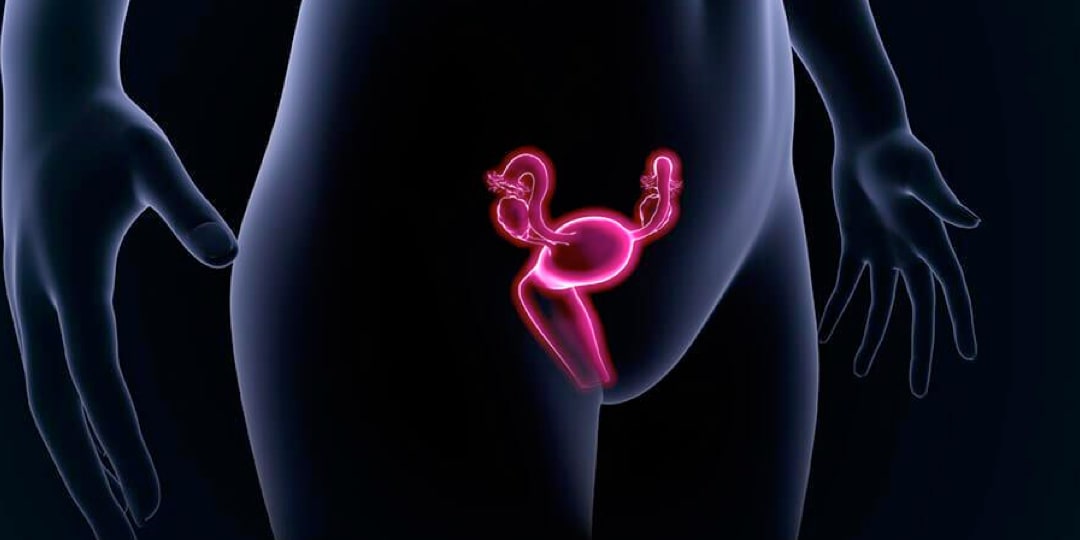Endometriyozis ve Çikolata Kistleri Nasıl Tedavi Edilir?
